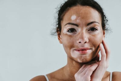 Entenda mais sobre a origem, sintomas e o que causa vitiligo!
